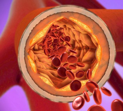 BP Cholesterol