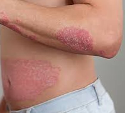 Skin Disease